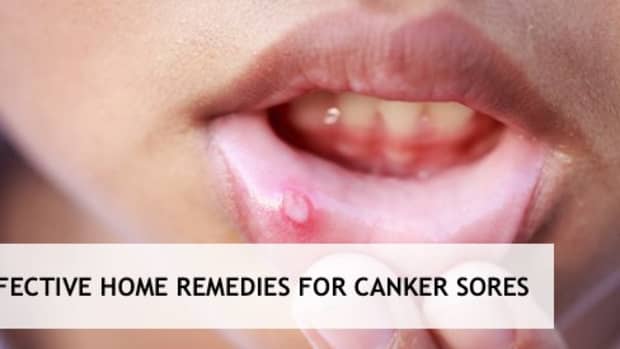 home-remedies-for-canker-sores-in-themouth