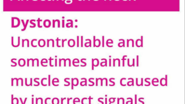 what-is-cervical-dystonia