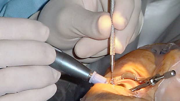 5-key-considerations-for-cataract-surgery