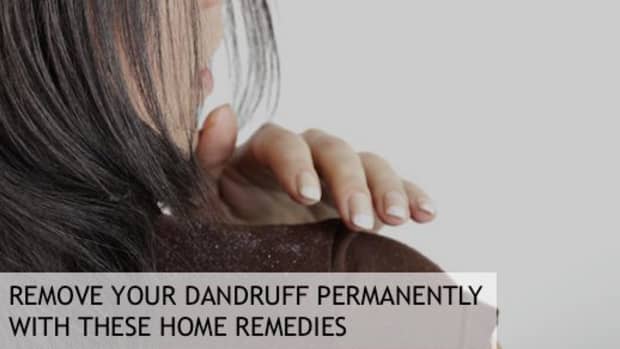 how-to-remove-dandruff-permanently