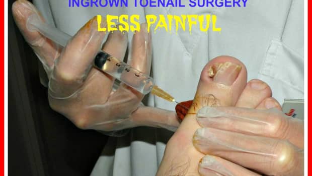 how-to-make-ingrown-toenail-surgery-less-painful