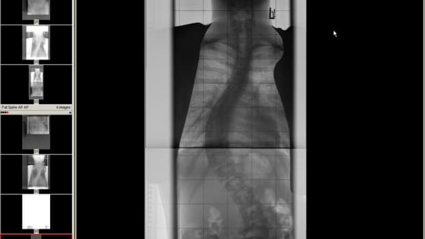 youve-been-diagnosed-with-scoliosis-now-what