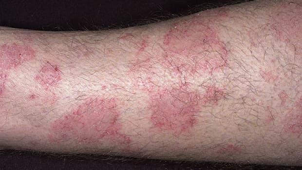 how-to-deal-with-eczema