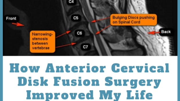anterior-cervical-disk-fusion-surgery-acdf-my-experience