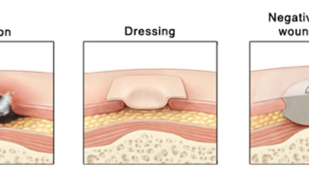 pressure-ulcers-treatment-and-prevention