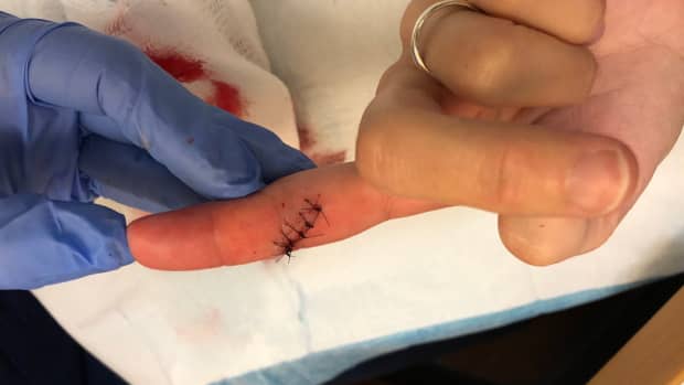how-to-restore-feeling-in-a-numb-finger-after-stitches
