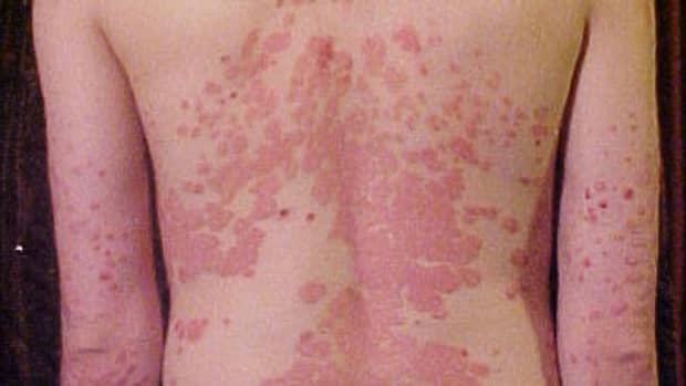 effective-home-remedies-for-psoriasis