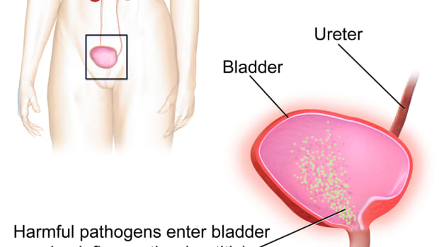 home-remedies-for-bladder-infections