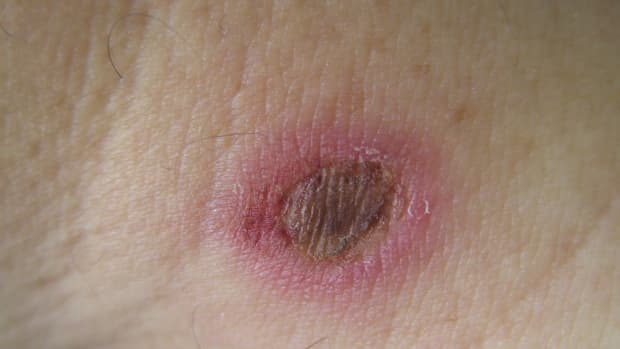 home-remedies-for-first-degree-burns