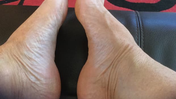 plantar-fasciitis-heel-and-foot-pain