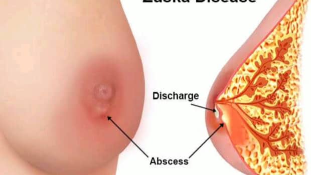 breast-abscesses-and-i-dealt-with-them