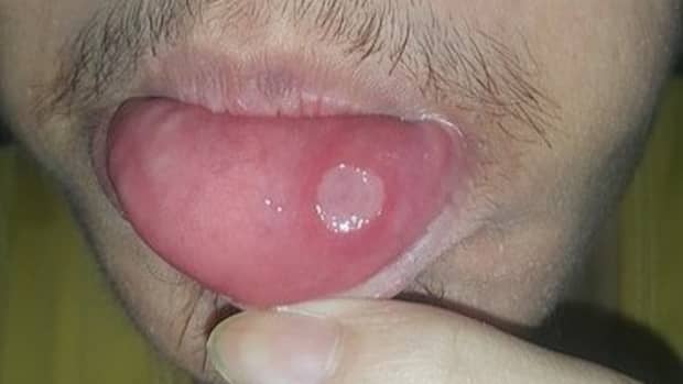 a-simple-way-to-prevent-canker-sores