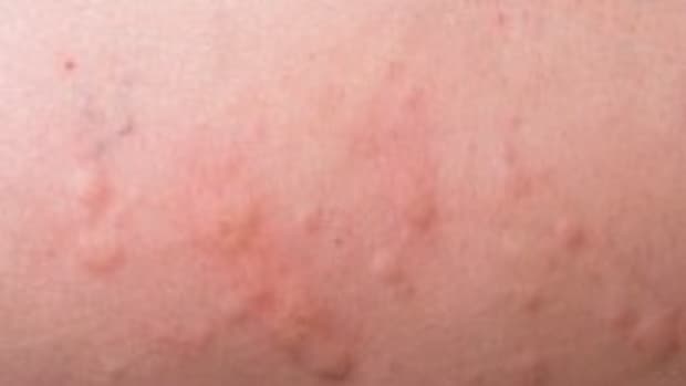 how-to-treat-hives-in-children