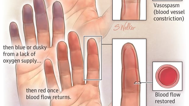 what-is-raynauds-and-how-to-manage-it