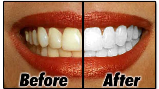 whiter-teeth-and-teeth-whitening-reviews-and-frequently-asked-questions