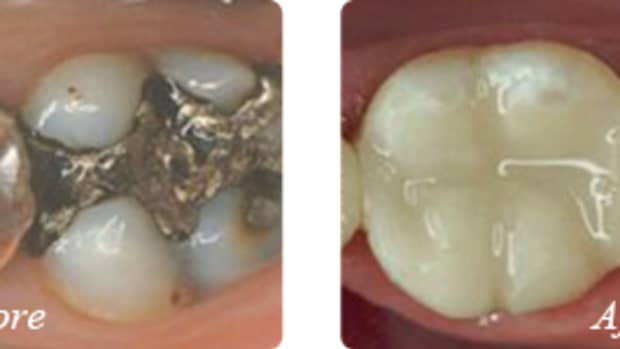 dangers-of-amalgam-dental-fillings