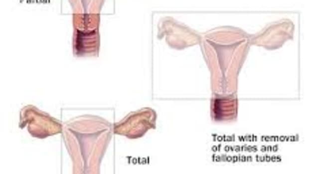 total-hysterectomy-at-25-the-consequences-and-benefits-to-the-surgery-on-a-young-woman