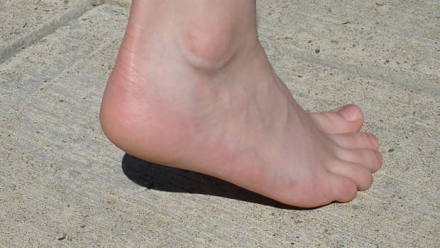 How to Heal Cracked Heels Naturally