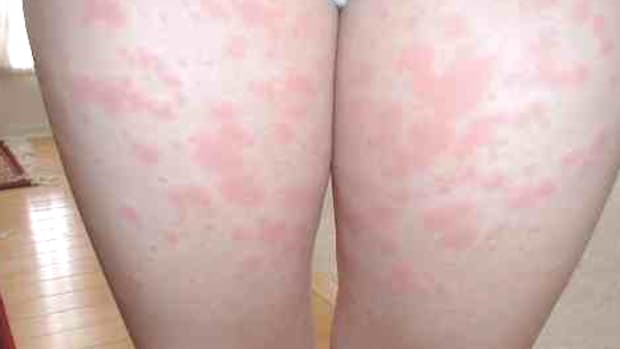 lamictal-rash-symptoms-treatment-images