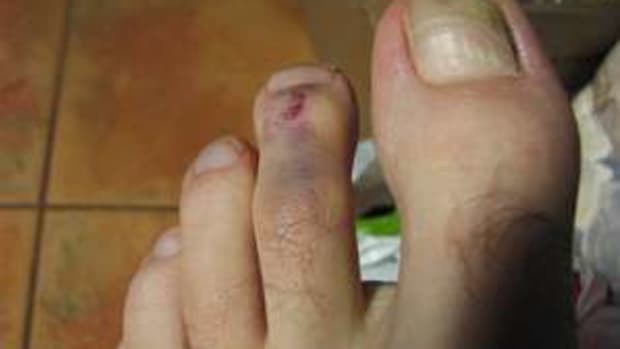 what-to-do-for-a-broken-toe