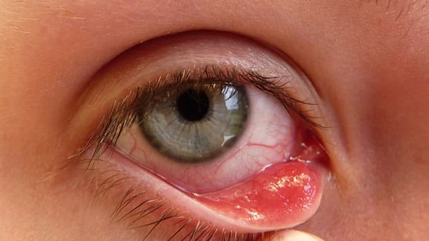how-to-get-rid-of-a-stye