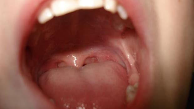 tonsil-stones-causing-bad-breath-heres-how-to-get-rid-of-them
