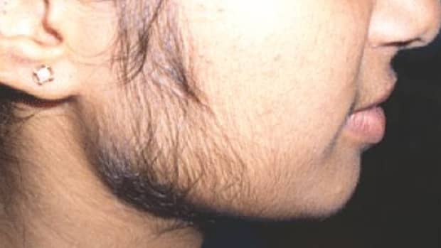 womens-facial-hair-removal
