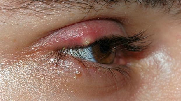 ingrown-eyelash-trichiasis