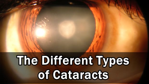 the-different-types-of-cataracts