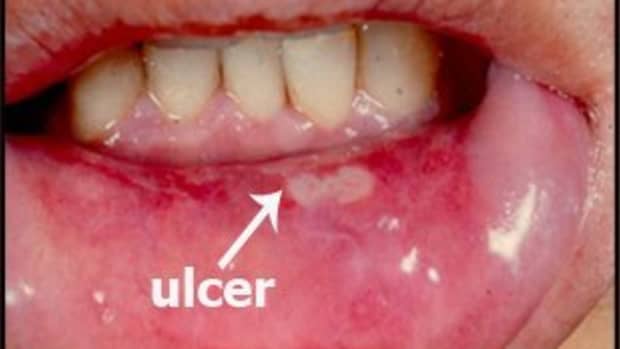 natural-remedies-for-mouth-ulcers