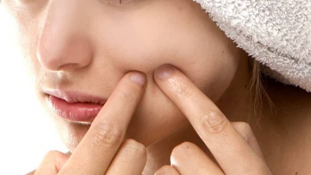 blackheads-and-how-to-get-clear-skin