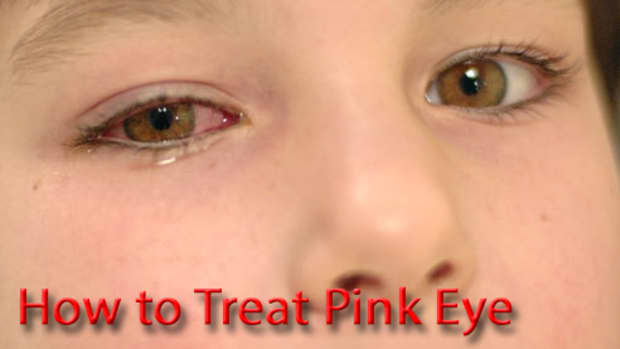 how-to-get-rid-of-pink-eye-treatments-and-pink-eye-home-remedy