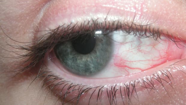 red-eyes-itchy-eyes-sore-eyes-causes-symptoms-and-solutions