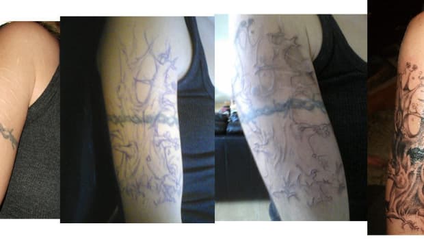 attempting-to-remove-a-tattoo-at-home