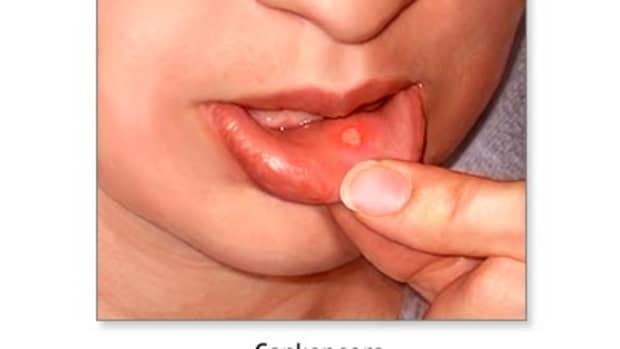 how-to-treat-and-prevent-mouth-ulcers