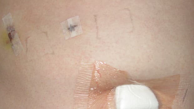 This is what my incisions looked like a few days after having my gallbladder removed.