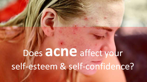regain-your_self-esteem-and-self-confidence_fight-acne-aggressively