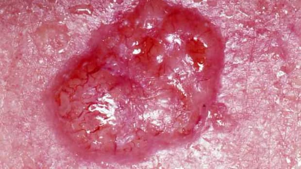 basal-cell-carcinoma-the-good-skin-cancer