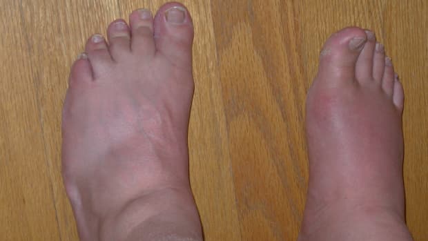 8-foods-to-avoid-with-gout