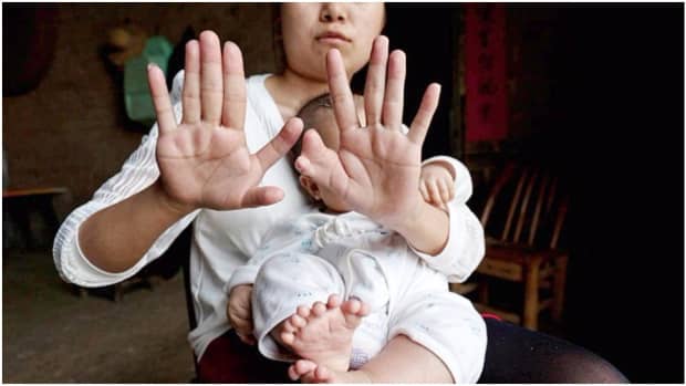polydactyly-the-curious-congenital-anomaly-found-in-humans