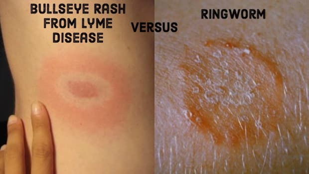ringworm-vs-lyme-disease-how-to-tell-the-difference-between-the-bulls-eye-rash