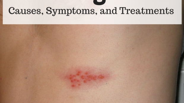 shingles-a-serious-painful-viral-disease