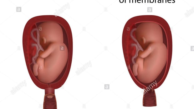 prom-pre-mature-rupture-of-membrane-at-22-weeks-of-pregnancy