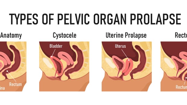 uterine-prolapse-and-vaginal-prolapse
