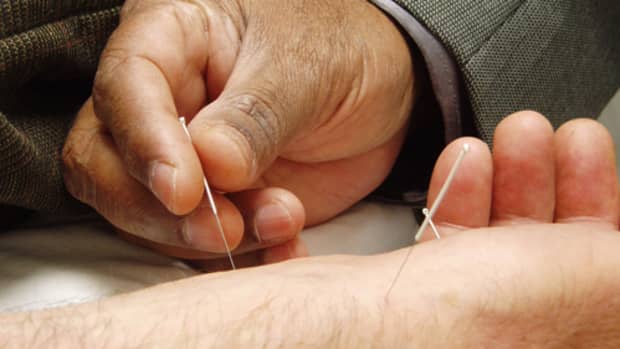 what-is-acupunture