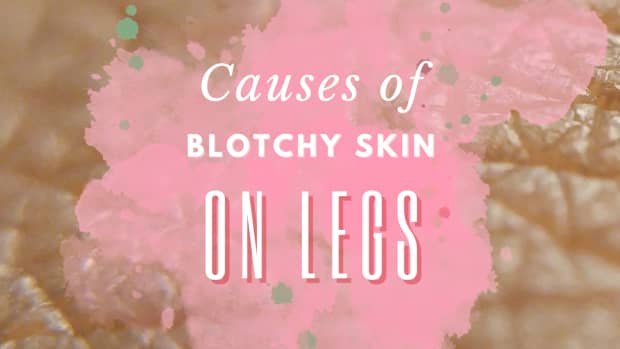 what-causes-blotchy-skin-on-legs