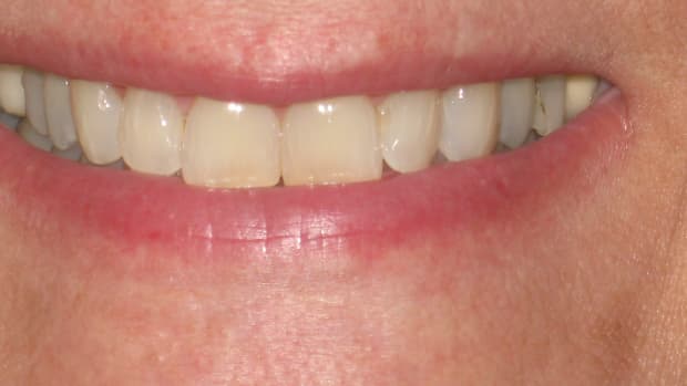 teeth-whitening-at-home-in-three-days-over-the-counter-product-by-cvs-for-less-than-twenty-dollars