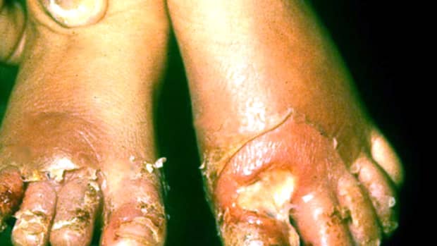 congenital-syphilis-clinical-manifestations-health-implications-and-lesions