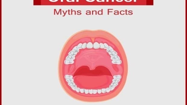 This article describes oral cancer myths and facts.