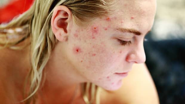 how-to-eliminate-acne-through-an-anti-acne-diet